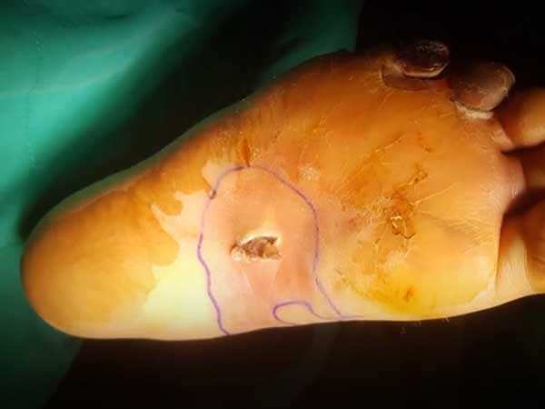 Nghĩ bị nhiễm trùng nặng do mang dép kẹp, đến khi đi khám bệnh người phụ nữ này mới tá hỏa vì mắc phải căn bệnh nguy hiểm