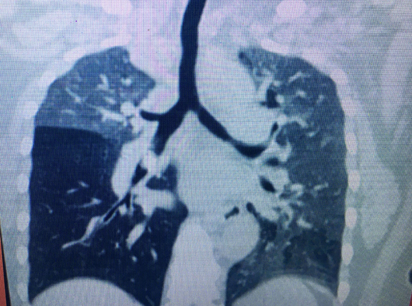 Chiếc xương vịt nằm trong đường thở suốt 10 tháng người phụ nữ Việt