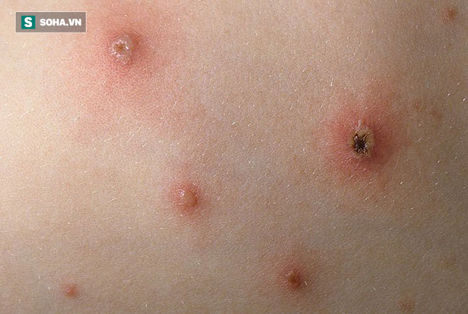 Thủy đậu đang vào mùa: Dấu hiệu sớm nhất, cách chăm sóc và phòng bệnh bạn nên làm ngay