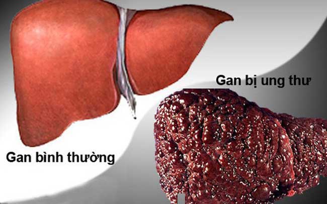 Ung thư gan đứng đầu trong các bệnh ung thư ở VN: GĐ BV Ung bướu chỉ 5 dấu hiệu cảnh báo