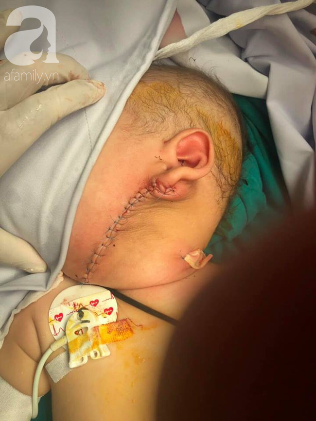 Người mẹ Sài Gòn đau khổ tột cùng vì con trai 12 tháng tuổi mang gương mặt quỷ, má phình to như quả bưởi