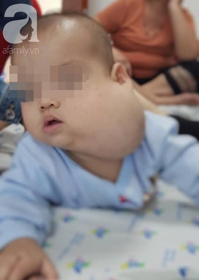 Người mẹ Sài Gòn đau khổ tột cùng vì con trai 12 tháng tuổi mang gương mặt quỷ, má phình to như quả bưởi