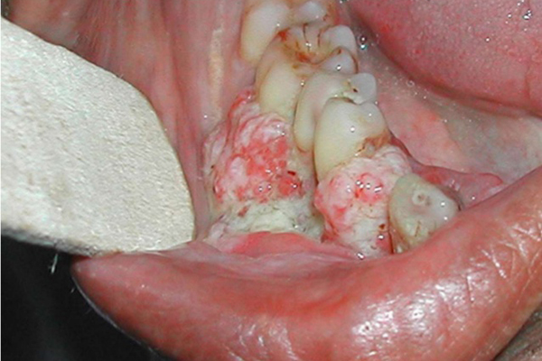 Tưởng bị nhiệt miệng, người đàn ông Hà Nội phải cắt 1 góc má vì ung thư