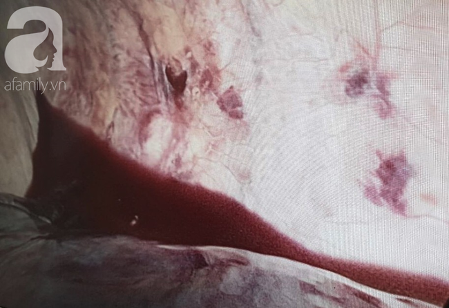 Tai nạn đau lòng: Đi làm mướn nuôi cha tâm thần, bé trai 13 tuổi bị thanh sắt máy cắt lúa đâm xuyên thấu ngực