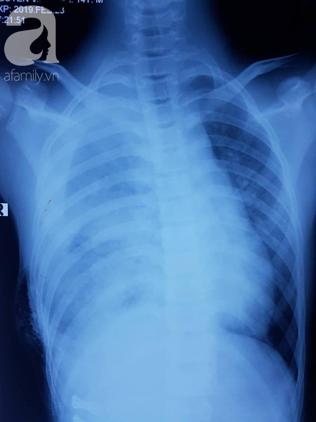 Tai nạn đau lòng: Đi làm mướn nuôi cha tâm thần, bé trai 13 tuổi bị thanh sắt máy cắt lúa đâm xuyên thấu ngực