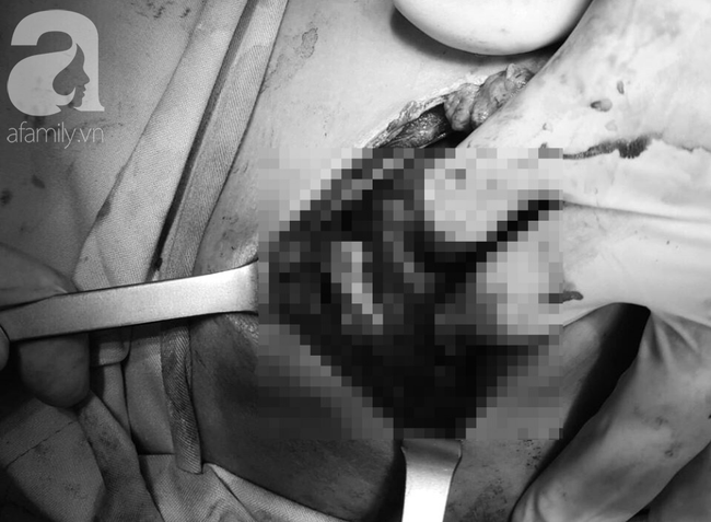 Tai nạn đau lòng: Đi làm mướn nuôi cha tâm thần, bé trai 13 tuổi bị thanh sắt máy cắt lúa đâm xuyên thấu ngực