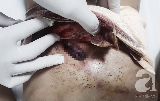 Tai nạn đau lòng: Đi làm mướn nuôi cha tâm thần, bé trai 13 tuổi bị thanh sắt máy cắt lúa đâm xuyên thấu ngực