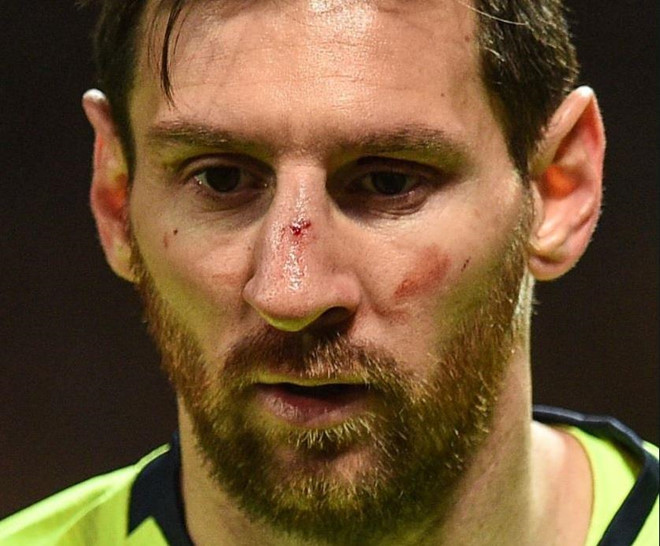 Messi tổn thương mắt nghiêm trọng, có thể nghỉ thi đấu 2 trận