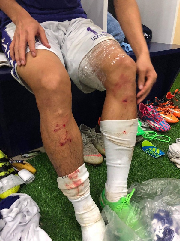 Rợn người với hình ảnh ống đồng của Văn Kiên sau khi lĩnh trọn cú xoạc bóng của Quế Ngọc Hải