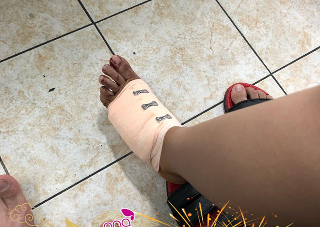 Phan Mạnh Quỳnh gặp tai nạn khi đi chơi 8/3, bạn gái phải khâu 20 mũi