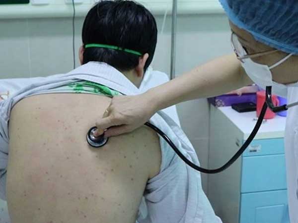 Hi hữu: Lần đầu tiên xuất hiện bệnh ho gà ở người lớn