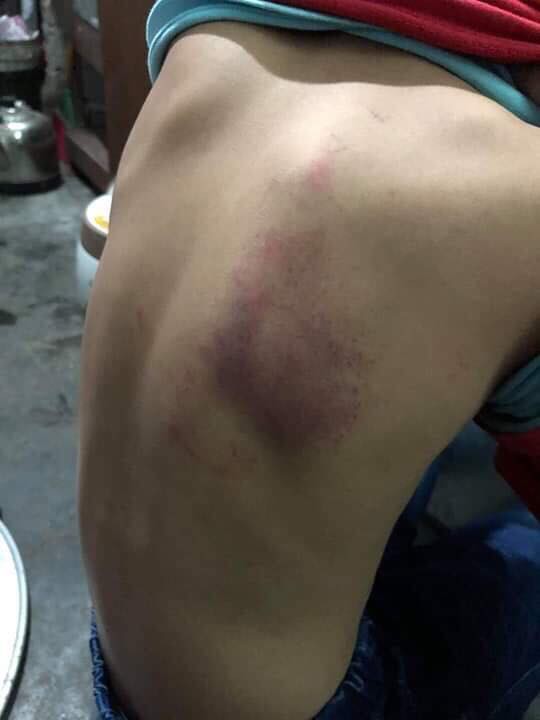 Hải Phòng: Cô giáo đánh học sinh tím lưng vì làm bài kém