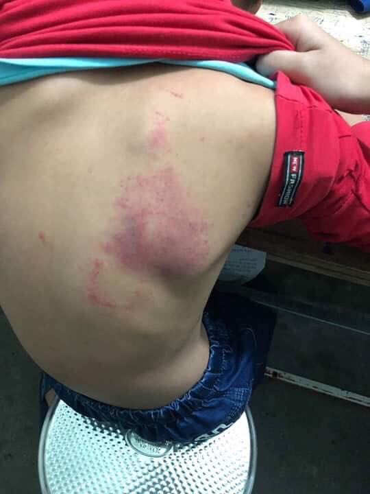 Hải Phòng: Cô giáo đánh học sinh tím lưng vì làm bài kém