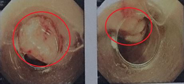 Nam sinh 18 tuổi ở Nghệ An mắc 3 bệnh ung thư cùng lúc