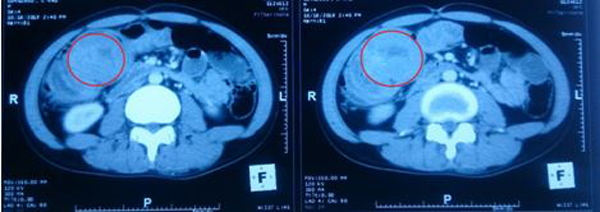 Nam sinh 18 tuổi ở Nghệ An mắc 3 bệnh ung thư cùng lúc