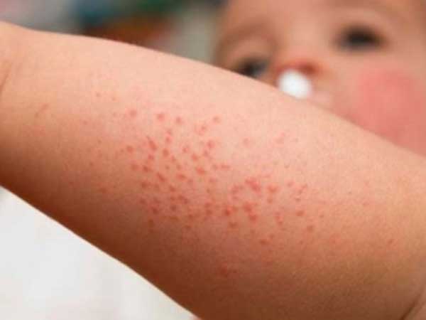 Cách phân biệt sởi với các phát ban dạng sởi