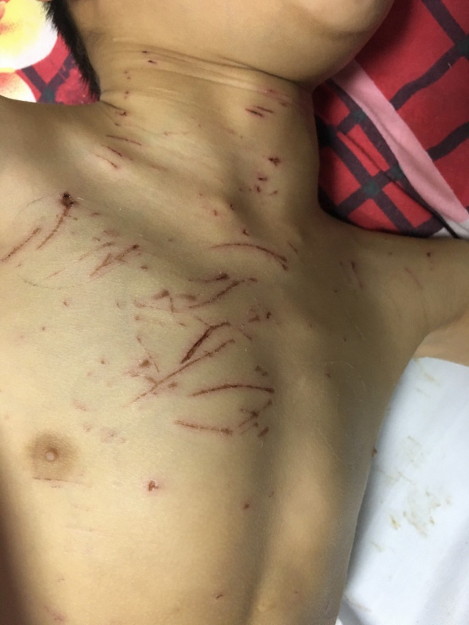 Yên Bái: Bé trai 9 tuổi bại não bị 4 con chó của nhà trèo lên giường cắn đứt vùng kín