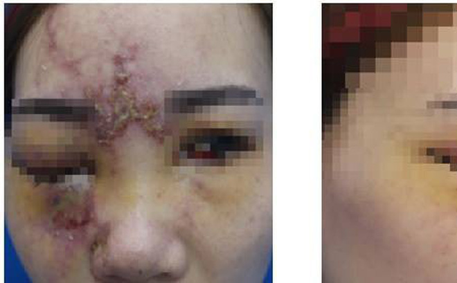 Cô gái 27 tuổi mù một bên mắt sau khi nâng mũi