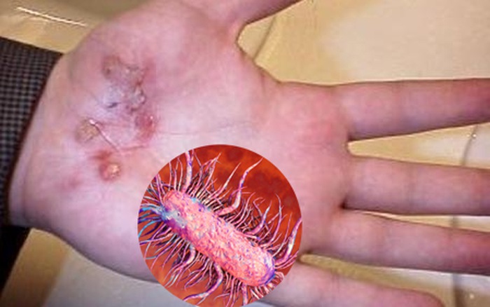 Nghĩ cơn đau vùng hậu môn là bệnh trĩ: Bệnh nhân nhiễm vi khuẩn ăn thịt người, thối ruột mà không hay