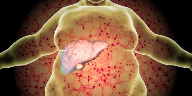 Cô gái 18 tuổi mắc bệnh gan nhiễm mỡ chỉ vì kiêng ăn một chất quan trọng trong bữa ăn hàng ngày