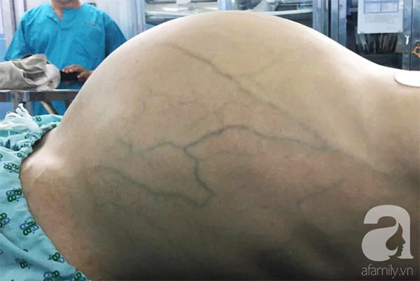 Mới 25 tuổi nhưng đã mang u buồng trứng 25kg: Cảnh báo chị em thấy bụng to ra, tiêu tiểu bất thường đừng chủ quan