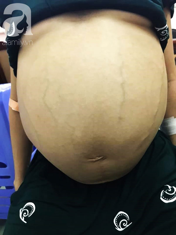 Mới 25 tuổi nhưng đã mang u buồng trứng 25kg: Cảnh báo chị em thấy bụng to ra, tiêu tiểu bất thường đừng chủ quan