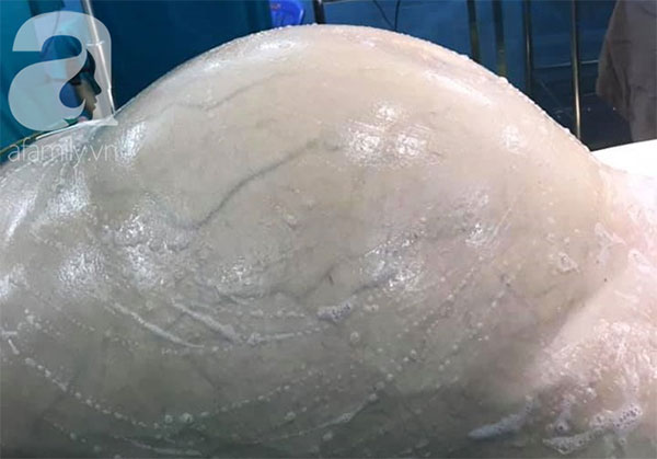 Mới 25 tuổi nhưng đã mang u buồng trứng 25kg: Cảnh báo chị em thấy bụng to ra, tiêu tiểu bất thường đừng chủ quan