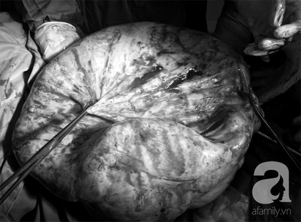 Mới 25 tuổi nhưng đã mang u buồng trứng 25kg: Cảnh báo chị em thấy bụng to ra, tiêu tiểu bất thường đừng chủ quan