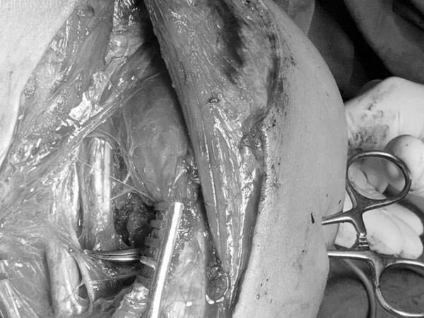 Đồng Nai: Xô xát khi đi chơi, thanh niên 20 tuổi bị nhóm người lạ phóng dao xuyên vai, liệt tay