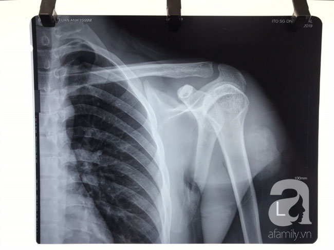 Đồng Nai: Xô xát khi đi chơi, thanh niên 20 tuổi bị nhóm người lạ phóng dao xuyên vai, liệt tay