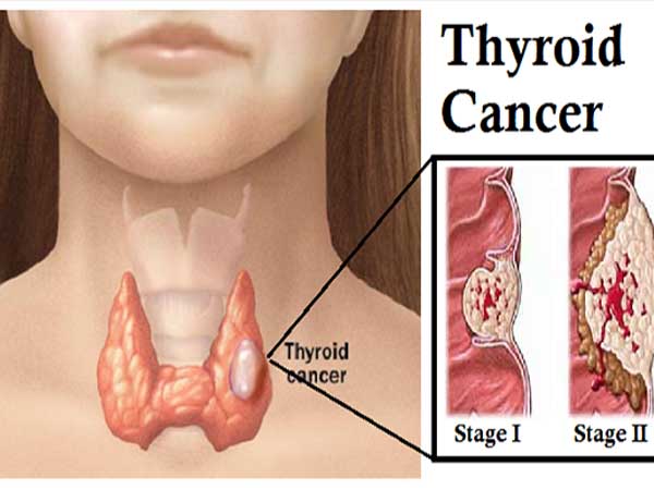 Hai chị em sinh đôi cùng mắc 1 bệnh ung thư: Bác sĩ chỉ ra dấu hiệu cần nhớ