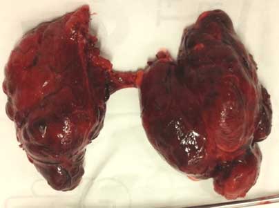 Hai chị em sinh đôi cùng mắc 1 bệnh ung thư: Bác sĩ chỉ ra dấu hiệu cần nhớ