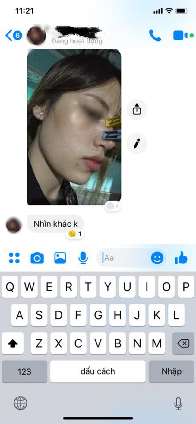 Muốn đẹp không tốn kém, cô gái trẻ tin lời chị em cây khế tư vấn dùng kẹp quần áo để nâng mũi