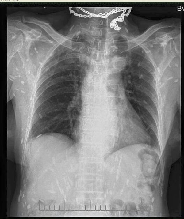 Từ vụ nhiễm sán lợn: Đây mới là con đường dẫn đến bị nhiễm sán kinh hoàng nhất