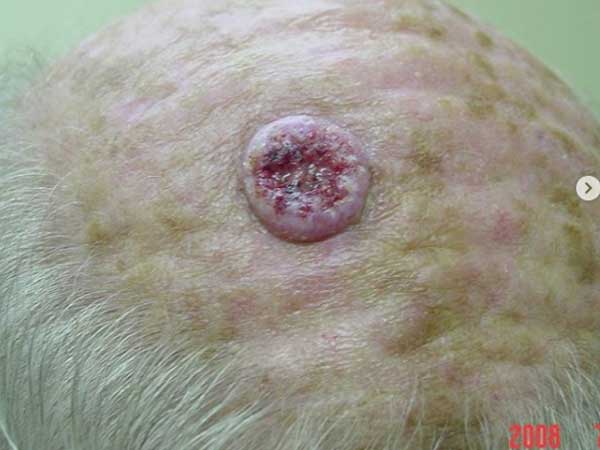 Chiếc lỗ đẫm máu trên đầu người đàn ông này chính là dấu hiệu cảnh báo một loại ung thư da nguy hiểm