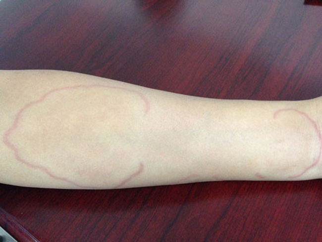 Dấu hiệu nhận biết những loại thịt tiềm ẩn nguy cơ nhiễm sán chẳng kém thịt lợn