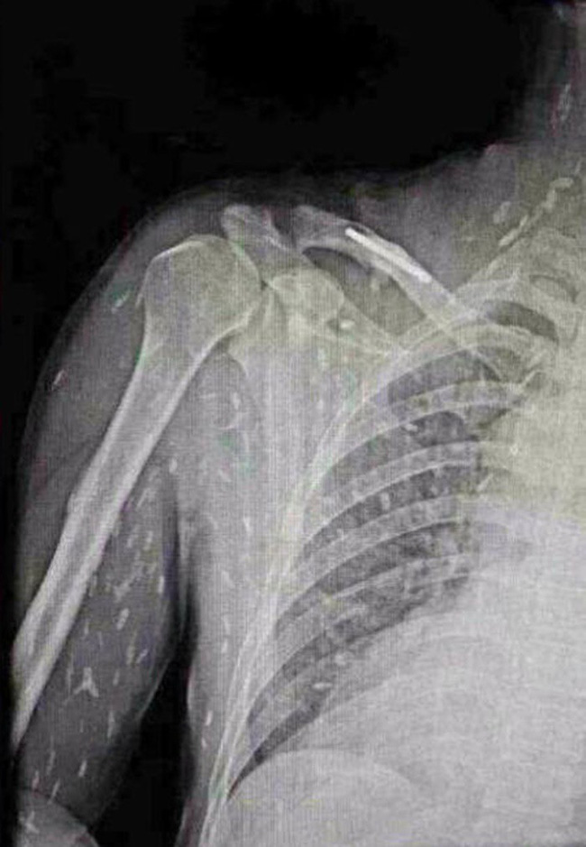 Người nhiễm sán toàn cơ thể, người nhung nhúc trứng sán dây trong não: Những bài học đau đớn từ thói quen ăn đồ tái, sống