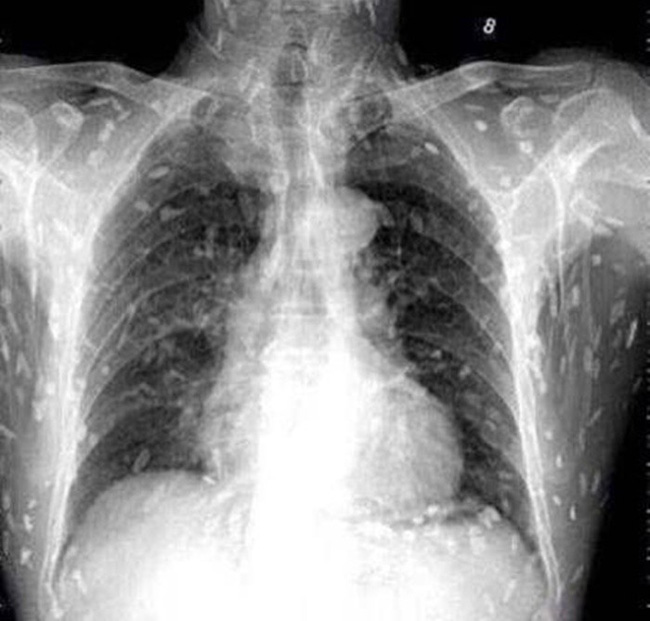 Người nhiễm sán toàn cơ thể, người nhung nhúc trứng sán dây trong não: Những bài học đau đớn từ thói quen ăn đồ tái, sống