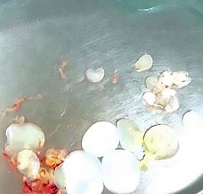 Người nhiễm sán toàn cơ thể, người nhung nhúc trứng sán dây trong não: Những bài học đau đớn từ thói quen ăn đồ tái, sống