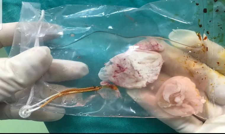 Bình luận Quý ông Phú Thọ bị sán làm tổ trong não vì món ăn nhiều người thích Bình luận Quý ông Phú Thọ bị sán làm tổ trong não vì món ăn nhiều người thích