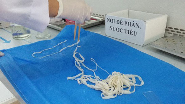 Bắt sán dây dài hơn 5 m khỏi cơ thể nữ giáo viên