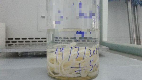 Bắt sán dây dài hơn 5 m khỏi cơ thể nữ giáo viên