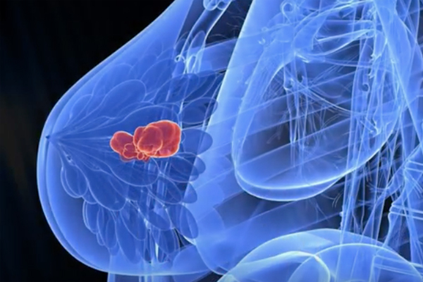 Thiếu nữ 17 phát hiện 2 khối u ở ngực, căn bệnh hơn 80% phụ nữ Việt mắc phải