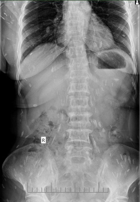 Nhập viện vì sán lá gan sinh sôi khắp cơ thể