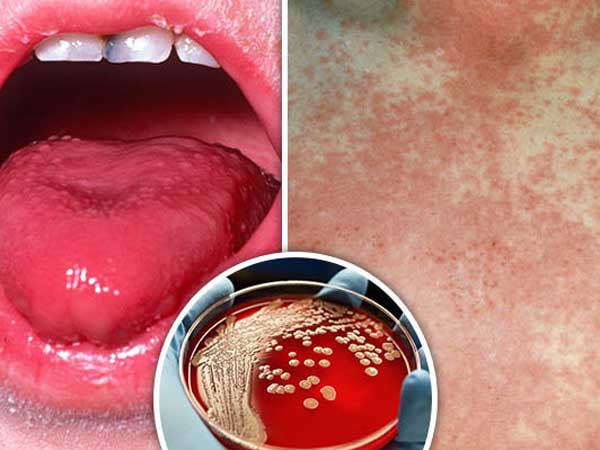 Lưỡi đỏ tươi khi sốt, cảnh báo căn bệnh cực kỳ nguy hiểm