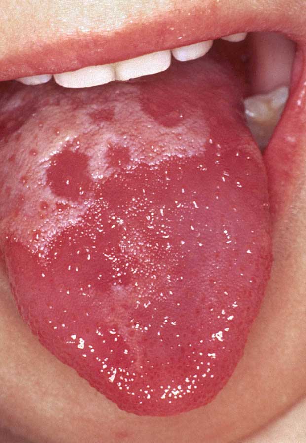 Lưỡi đỏ tươi khi sốt, cảnh báo căn bệnh cực kỳ nguy hiểm