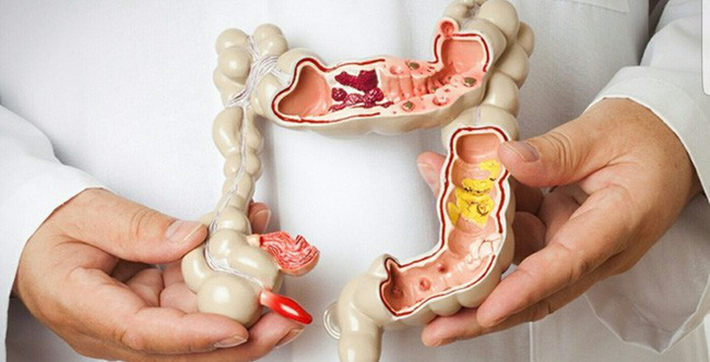 Người phụ nữ 26 tuổi bị ung thư: Bác sĩ cảnh báo có những phương pháp giảm cân ngàn vạn lần không nên lạm dụng Người phụ nữ 26 tuổi bị ung thư: Bác sĩ cảnh báo có những phương pháp giảm cân ngàn vạn lần không nên lạm dụng