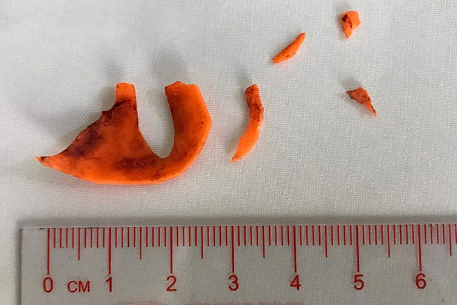 Cứu sống bé trai bị hóc mảnh đồ chơi xúc xắc nhiều tháng