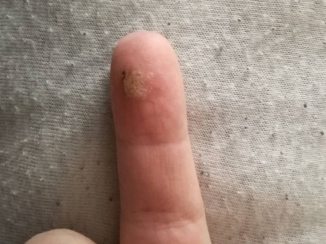 Điện thoại Nokia bất ngờ phát nổ khiến người dùng bị bỏng