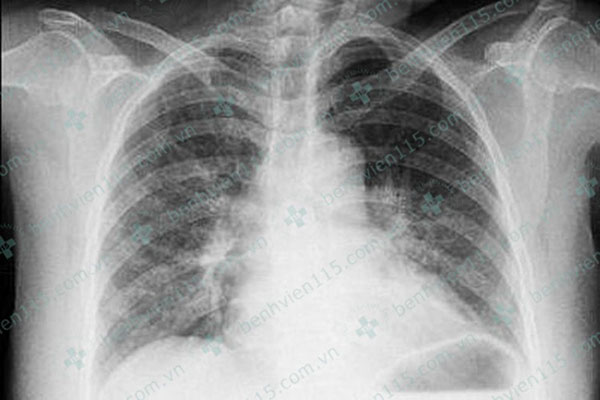 Nữ bệnh nhân bị nhồi máu cơ tim cấp do ong đốt và khuyến cáo của bác sĩ cho người trẻ tuổi